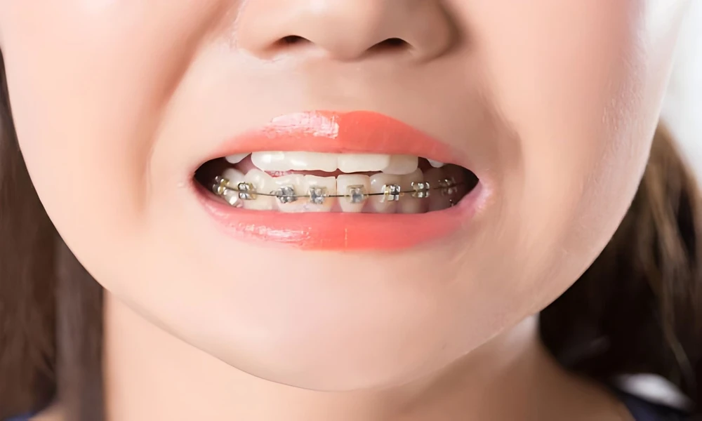 Crooked Teeth to Bite Problems – What Metal Braces Can Fix
